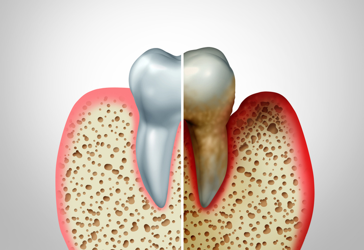 Tooth anatomy comparison, healthy vs. diseased