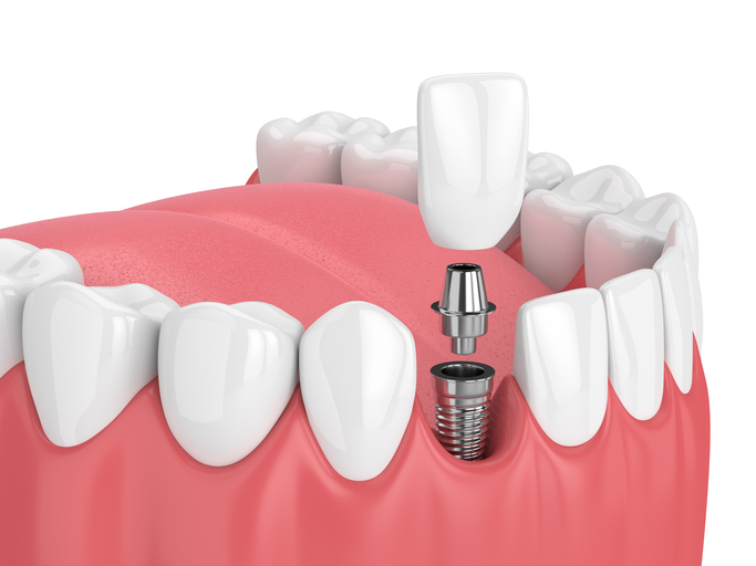 3d render of jaw with teeth and dental incisor implant
