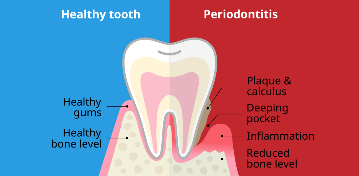 hdr_Services_Restore_GumDisease diagram of gum disease treatment in Independence MO