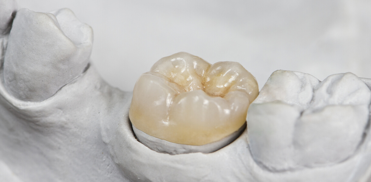 Dental Excellence inlays and onlays in Independence MO