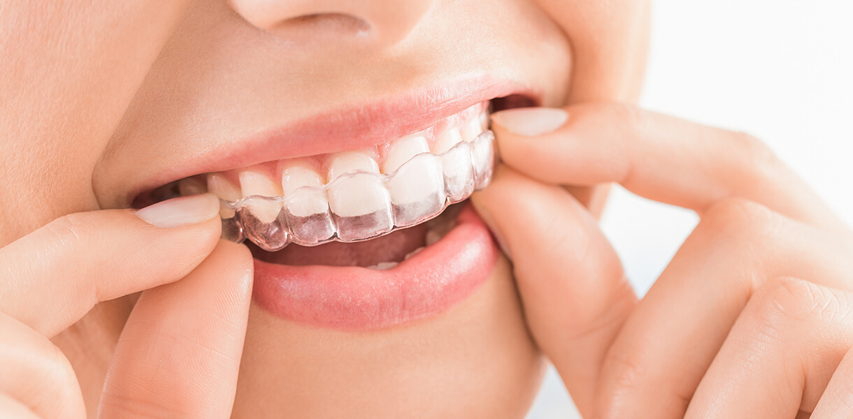 Dental Excellence Invisalign in Independence MO