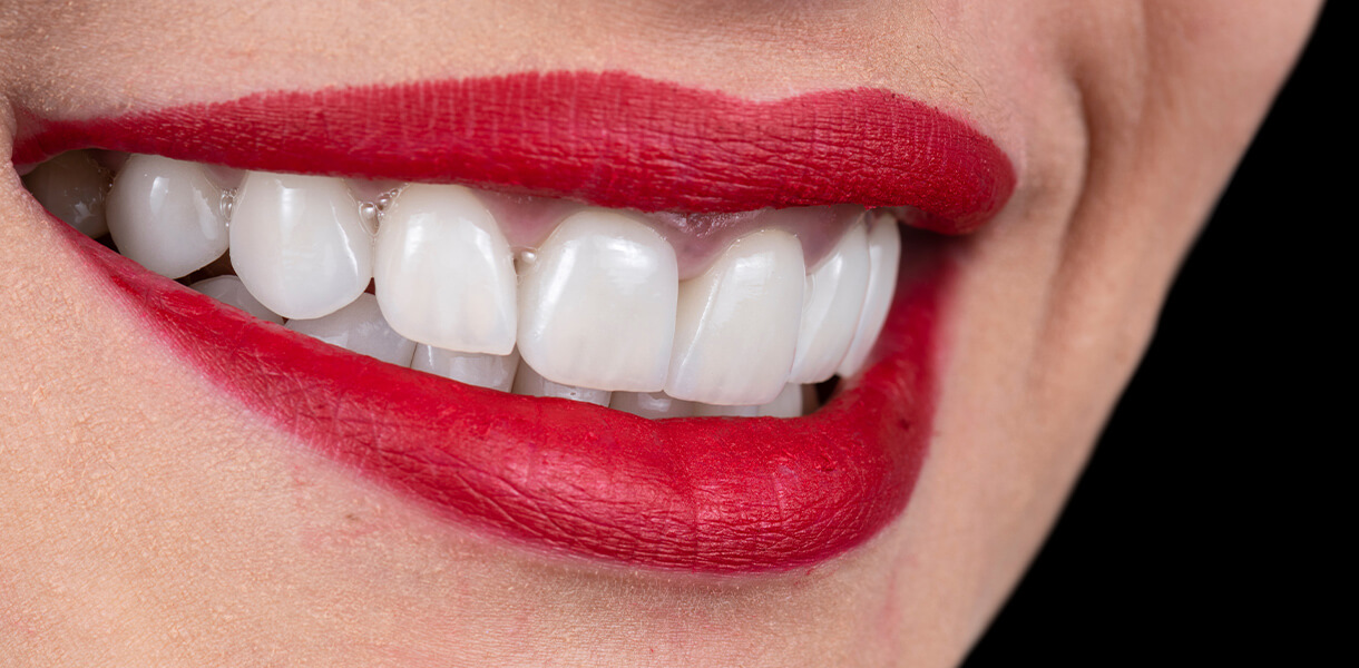 Dental Excellence Dental Veneers in Independence MO
